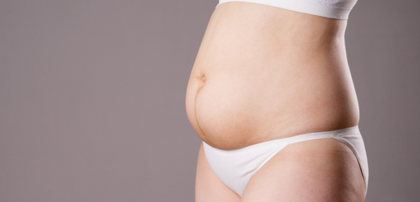 Diastasis Recti – serious problem no one talks about.